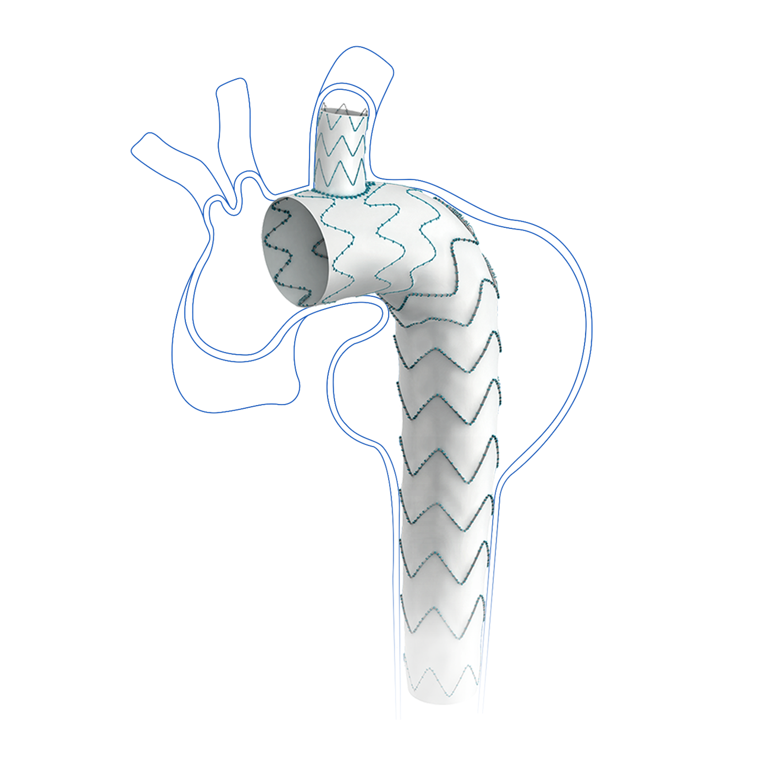 Cratos™ Branched Aortic Stent Graft System